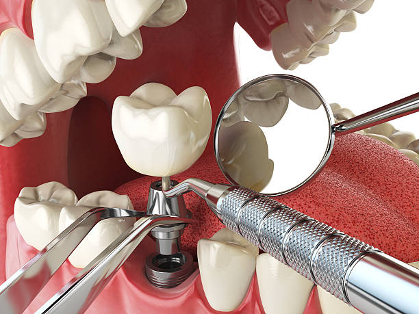 Best Emergency Denture Repair in Christopher, IL
